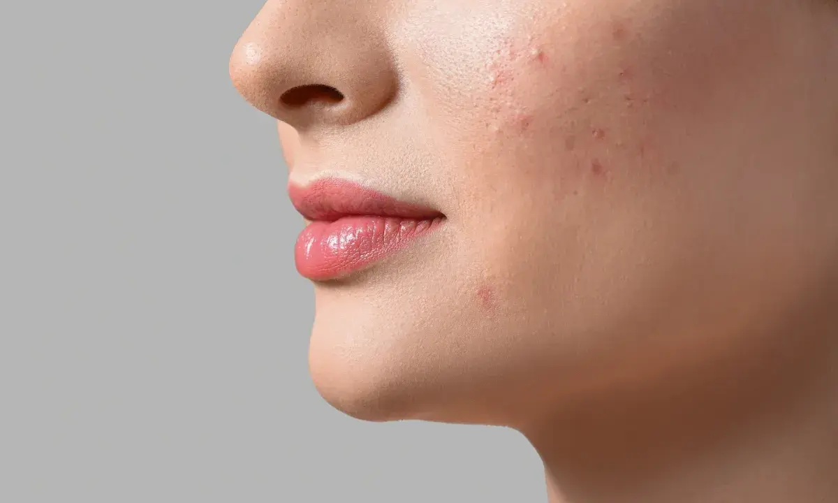 Aha, cos'è! Un primo piano del viso di una donna con rossetto rosa e alcuni brufoli sul viso.