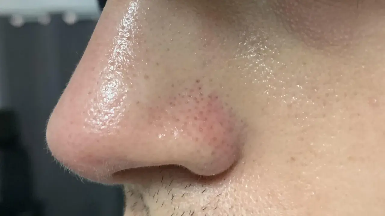 Primo piano del naso con pori visibili e alcuni filamenti sebacei. La pelle è leggermente lucida.