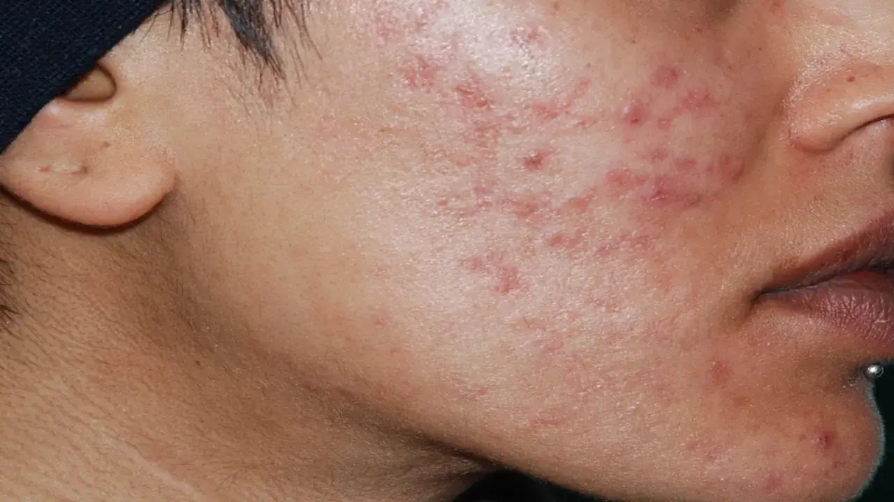 Primo piano del viso con acne cistica, alla ricerca di una cura definitiva.