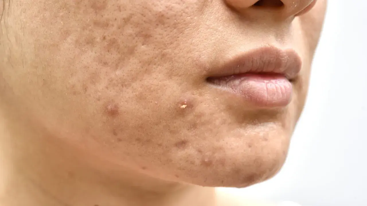 Primo piano del viso con imperfezioni, pori dilatati e brufoli. Potrebbe indicare una carenza di vitamina D nella pelle.