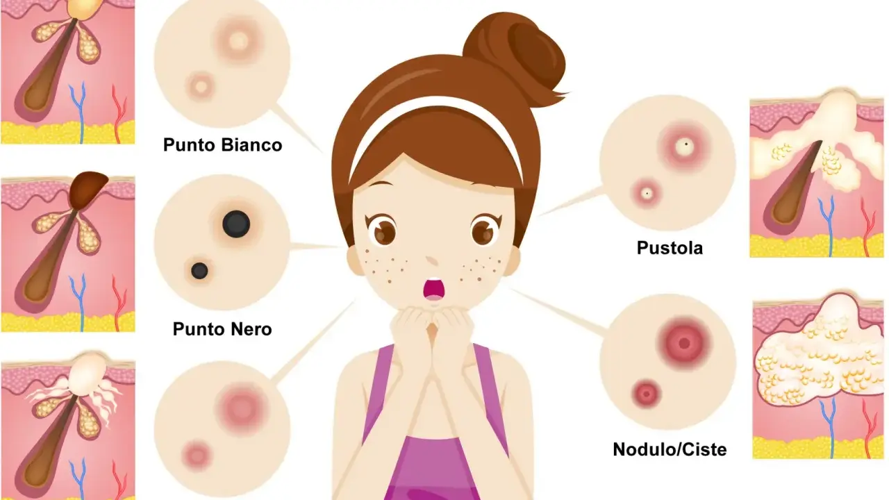 Ragazza con brufoli, punti neri e bianchi, papule, pustole e noduli/cisti. Illustrazione medica.
