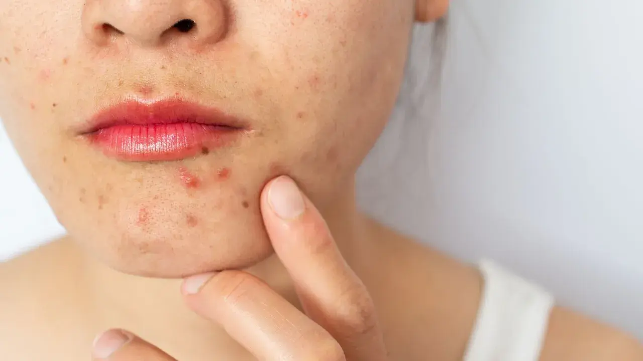 Primo piano del viso di una donna con evidenti segni di acne cistica intorno alla bocca e sul mento.