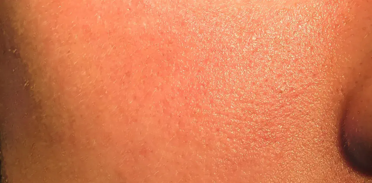 Pelle arrossata e secca, con piccole scaglie visibili. Potrebbe essere un'irritazione da retinolo: cosa fare per lenirla e ripristinare l'idratazione.