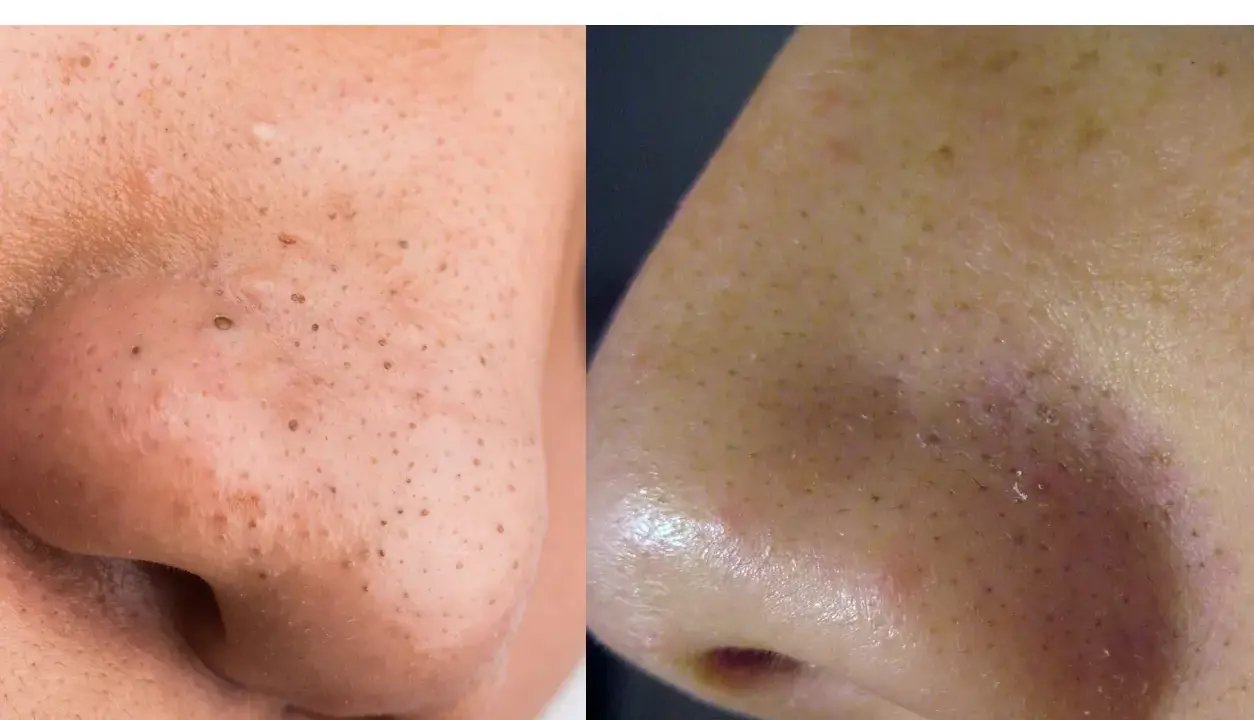 Confronto tra punti neri e filamenti sebacei sul naso. La pelle mostra pori dilatati e imperfezioni.