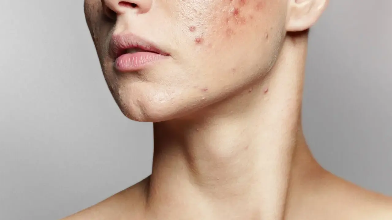Primo piano del viso di una persona con imperfezioni e pelle secca, evidenziando rossori e brufoli sul collo e sulla guancia.