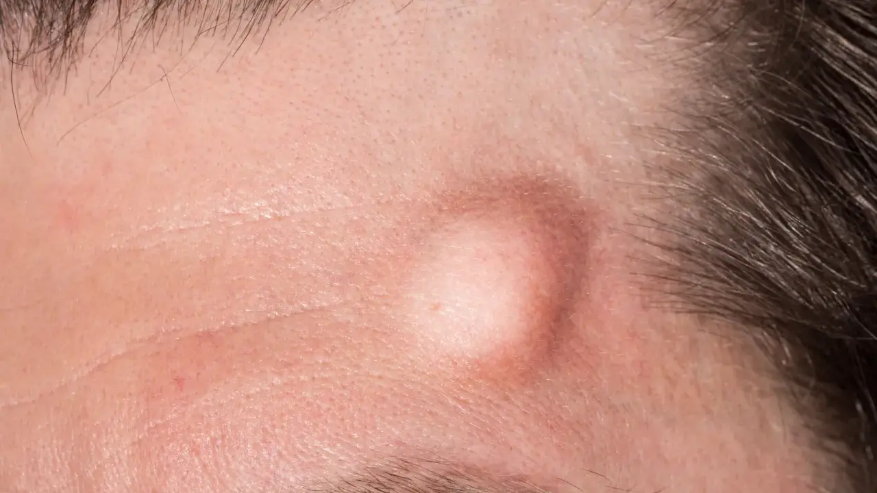 Una protuberanza pelle sulla fronte, circondata da capelli scuri e rughe sottili.
