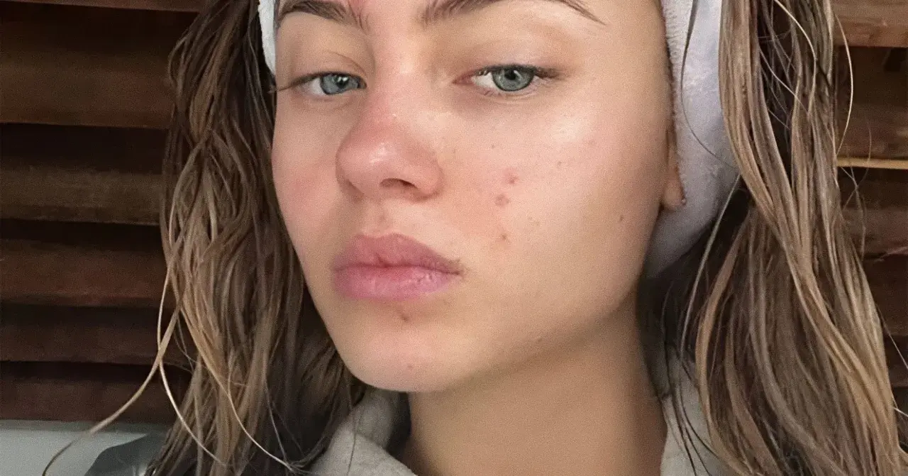 Viso di giovane donna con rossori e brufoli, segni del retinol purging. Capelli castani umidi, fascia bianca in testa.