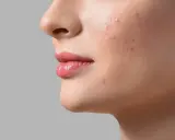 Aha, cos'è! Un primo piano del viso di una donna con rossetto rosa e alcuni brufoli sul viso.