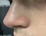 Primo piano del naso con pori visibili e alcuni filamenti sebacei. La pelle è leggermente lucida.