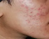 Primo piano del viso con acne cistica, alla ricerca di una cura definitiva.