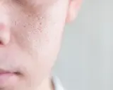 Primo piano della pelle del viso con pori dilatati, un dettaglio che mostra la texture e le imperfezioni, suggerendo la ricerca di come chiudere i pori del viso.