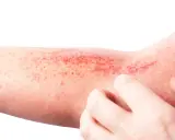 Un braccio con arrossamenti e piccole bollicine, segno di un prurito insistente.