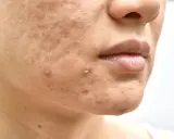 Primo piano del viso con imperfezioni, pori dilatati e brufoli. Potrebbe indicare una carenza di vitamina D nella pelle.