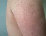 Pelle del braccio con piccoli puntini rossi e bianchi, tipici della cheratosi pilare.