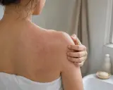 Donna con eruzione cutanea rossa sulla schiena e sulle spalle, che si gratta per il prurito dopo la doccia.