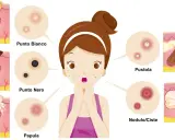 Ragazza con brufoli, punti neri e bianchi, papule, pustole e noduli/cisti. Illustrazione medica.