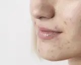 Primo piano del viso di una giovane donna con macchie scure sulla pelle, evidenti segni di acne sul mento e guancia.