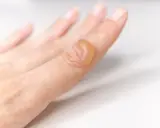 Dito, un dito con bolle da scottatura, segno di un contatto accidentale con calore.