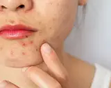 Primo piano del viso di una donna con evidenti segni di acne cistica intorno alla bocca e sul mento.