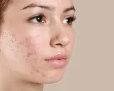Primo piano del viso di una giovane donna con pelle secca e squamosa, arrossamenti e imperfezioni.