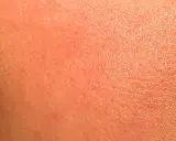 Pelle arrossata e secca, con piccole scaglie visibili. Potrebbe essere un'irritazione da retinolo: cosa fare per lenirla e ripristinare l'idratazione.