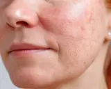 Primo piano del viso con pelle desquamata, rossori e pori dilatati.
