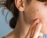 Primo piano del viso di una giovane donna con pelle invecchiata dal sole, macchie e brufoli.