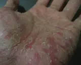 Mani che si spellano, con pelle secca e screpolata, arrossata in alcuni punti.