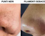 Confronto tra punti neri e filamenti sebacei sul naso. La pelle mostra pori dilatati e imperfezioni.