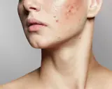 Primo piano del viso di una persona con imperfezioni e pelle secca, evidenziando rossori e brufoli sul collo e sulla guancia.