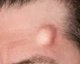 Una protuberanza pelle sulla fronte, circondata da capelli scuri e rughe sottili.