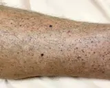 Pelle di una gamba con numerosi puntini rossi e viola, alcuni più scuri, distribuiti su un fondo leggermente arrossato e con peli.