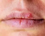 Labbra secche e screpolate, con piccole lesioni e labbra che si ritirano in alcuni punti, mostrando la pelle sottostante.