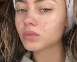 Viso di giovane donna con rossori e brufoli, segni del retinol purging. Capelli castani umidi, fascia bianca in testa.
