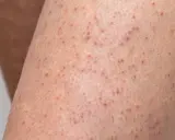 Pelle delle braccia con numerosi piccoli brufoli sottopelle, alcuni rossastri, che creano un aspetto puntinato.