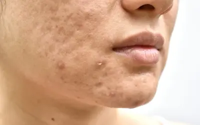 Primo piano del viso con imperfezioni, pori dilatati e brufoli. Potrebbe indicare una carenza di vitamina D nella pelle.