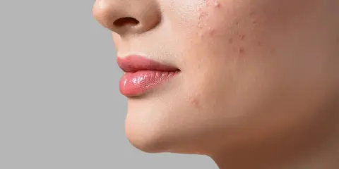 Aha, cos'è! Un primo piano del viso di una donna con rossetto rosa e alcuni brufoli sul viso.