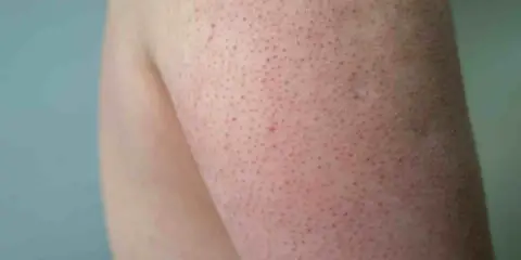 Pelle del braccio con piccoli puntini rossi e bianchi, tipici della cheratosi pilare.