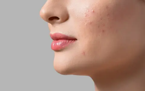 Aha, cos'è! Un primo piano del viso di una donna con rossetto rosa e alcuni brufoli sul viso.