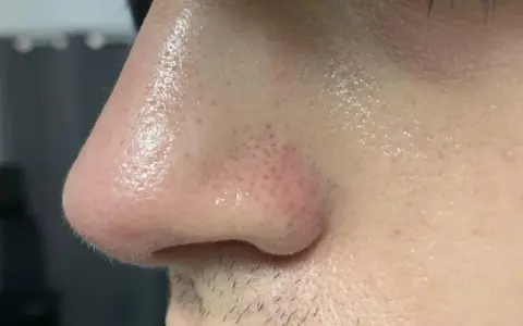 Primo piano del naso con pori visibili e alcuni filamenti sebacei. La pelle è leggermente lucida.