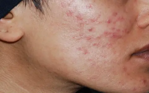 Primo piano del viso con acne cistica, alla ricerca di una cura definitiva.