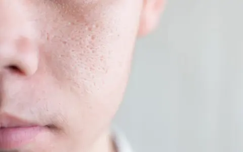 Primo piano della pelle del viso con pori dilatati, un dettaglio che mostra la texture e le imperfezioni, suggerendo la ricerca di come chiudere i pori del viso.