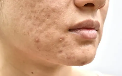 Primo piano del viso con imperfezioni, pori dilatati e brufoli. Potrebbe indicare una carenza di vitamina D nella pelle.