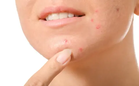 Dito un dito indica alcuni brufoli cistici sul viso di una persona, evidenziando la loro presenza.