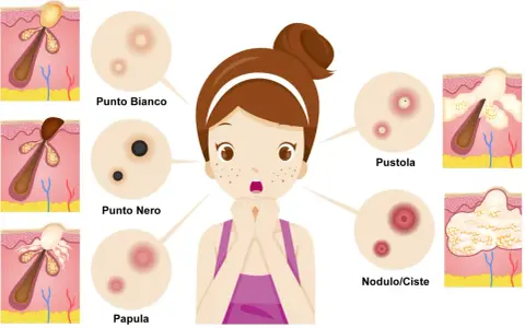 Ragazza con brufoli, punti neri e bianchi, papule, pustole e noduli/cisti. Illustrazione medica.
