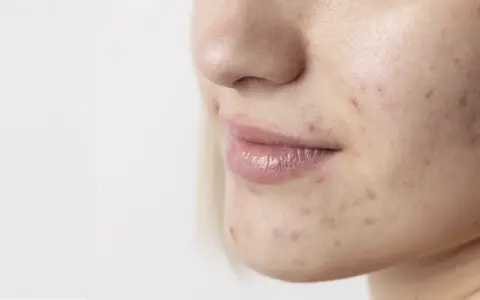 Primo piano del viso di una giovane donna con macchie scure sulla pelle, evidenti segni di acne sul mento e guancia.