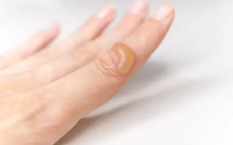 Dito, un dito con bolle da scottatura, segno di un contatto accidentale con calore.