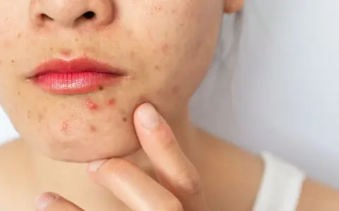 Primo piano del viso di una donna con evidenti segni di acne cistica intorno alla bocca e sul mento.