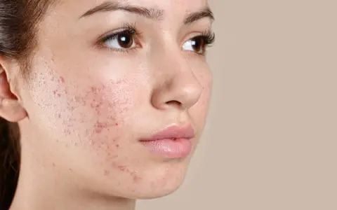 Primo piano del viso di una giovane donna con pelle secca e squamosa, arrossamenti e imperfezioni.