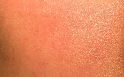 Pelle arrossata e secca, con piccole scaglie visibili. Potrebbe essere un'irritazione da retinolo: cosa fare per lenirla e ripristinare l'idratazione.